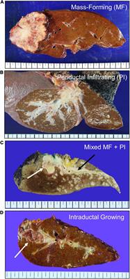 Up-to-Date Pathologic Classification and Molecular Characteristics of Intrahepatic Cholangiocarcinoma